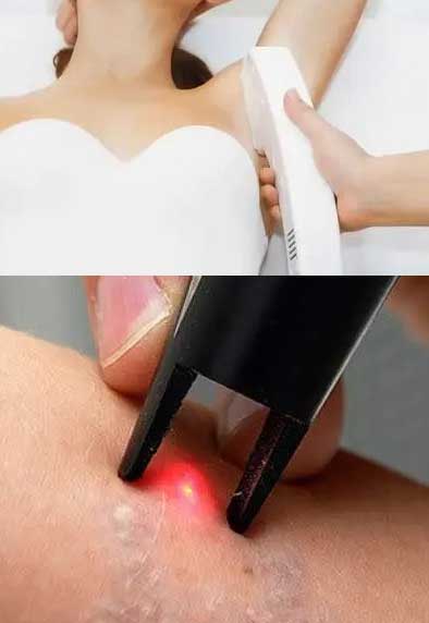 Nd YAG laser application